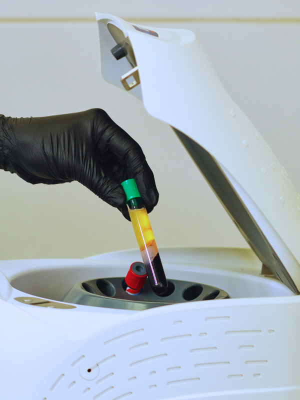 Gloved hand holding a test tube of separated PRGF plasma after centrifuge in Farmington Hills